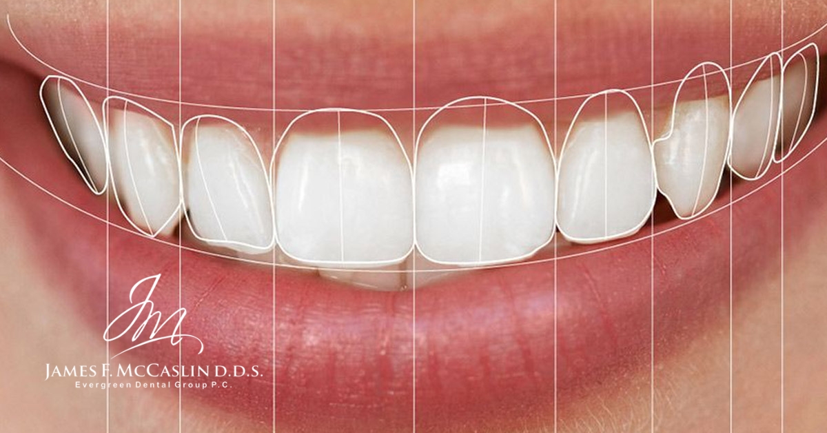 What is the Digital Smile Design Process? | Evergreen Dental Group